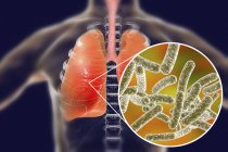Легені з хворобою Легіонерів і крупним планом бактерії пневмофіли Легіонелли, концептуальна ілюстрація . — стокове фото
