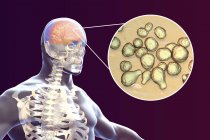 Meningitis in brain caused by fungi, digital illustration. — Stock Photo