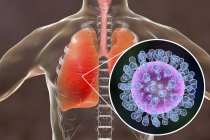 Silueta humana con pulmones infectados por neumonía causada por la gripe, ilustración . - foto de stock