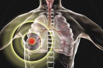 Silhueta humana mostrando tumor de câncer de pulmão, ilustração conceitual . — Fotografia de Stock