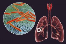 Faser-kavernöse Lungentuberkulose und Nahaufnahme von Mycobacterium tuberculosis-Bakterien. — Stockfoto