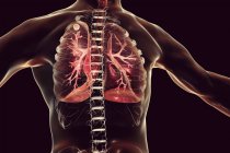 Цифровий ілюстрація твердих вузол у правої легені поблизу легенів apex при вторинних туберкульозу інфекції. — стокове фото