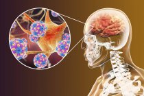 Encephalitis of human brain caused by measles enterovirus, conceptual illustration. — Stock Photo