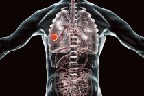 Силует людини, що показує пухлину раку легенів, концептуальна ілюстрація . — стокове фото