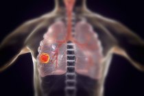 Silhueta humana mostrando tumor de câncer de pulmão, ilustração conceitual . — Fotografia de Stock