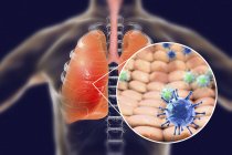 Menschliche Lungen mit viraler Lungenentzündung und Nahaufnahme von Virionen. — Stockfoto