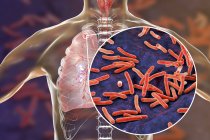 Infecção pulmonar secundária por tuberculose e close-up de bactérias Mycobacterium tuberculosis . — Fotografia de Stock
