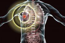 Silhouette umana che mostra il tumore del cancro al polmone, illustrazione concettuale . — Foto stock