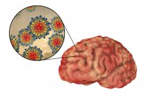 Encéphalite du cerveau humain causée par l'entérovirus de la rougeole, illustration conceptuelle . — Photo de stock