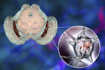 Цифровая иллюстрация выродившейся чёрной субстанции в мозгу во время болезни Паркинсона . — стоковое фото