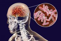 Konzeptionelle Darstellung des Gehirns mit Anzeichen einer bakteriellen Enzephalitis und Nahaufnahme von Bakterien. — Stockfoto