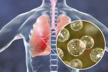 Menschliche Silhouette mit infizierter Lunge mit Lungenblastomykose und Nahaufnahme von Blastomyces dermatitidis-Pilzpartikeln. — Stockfoto