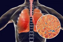 Keuchhusten ansteckende infektiöse Lungenkrankheit und Bordetella-Pertussis-Bakterien in Großaufnahme. — Stockfoto