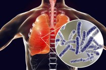 Lungen mit Legionärskrankheit und Nahaufnahme von Legionella pneumophila Bakterien, konzeptionelle Illustration. — Stockfoto