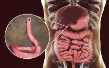 Digital illustration of parasitic hookworm Ancylostoma duodenale in small intestine. — Stock Photo
