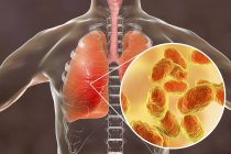 Polmonite polmonare e primo piano dei batteri Haemophilus influenzae, illustrazione digitale . — Foto stock