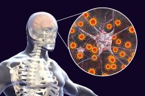Концептуальная иллюстрация человеческого мозга с признаками вирусного энцефалита и крупным планом вирусных частиц . — стоковое фото