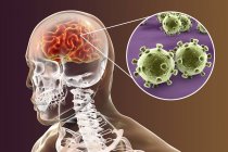 Концептуальна ілюстрація людського мозку з ознаками вірусного енцефаліту та крупним планом частинок вірусу . — стокове фото