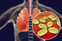 Легенева пневмонія і крупним планом бактерії грипу гемофілу, цифрова ілюстрація . — стокове фото