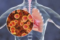 Neumonía pulmonar causada por la bacteria Mycoplasma pneumoniae, ilustración conceptual . - foto de stock