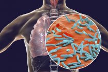 Sekundäre Tuberkulose-Lungeninfektion und Nahaufnahme von Mycobacterium tuberculosis-Bakterien. — Stockfoto