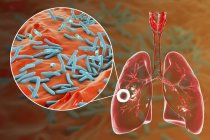 Tuberculose pulmonaire fibreuse-caverneuse et gros plan sur la bactérie Mycobacterium tuberculosis . — Photo de stock