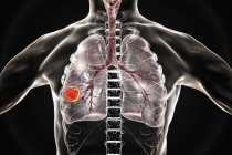 Silueta humana que muestra tumor de cáncer de pulmón, ilustración conceptual . - foto de stock