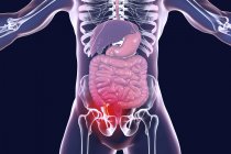 Ilustración digital de la silueta humana con apéndice rojo e inflamado en apendicitis . - foto de stock