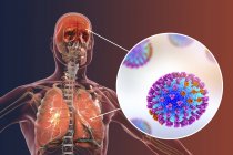 Illustrazione digitale della complicanza dell'infezione influenzale come polmonite ed encefalite e primo piano delle particelle virali
. — Foto stock