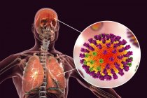 Цифровая иллюстрация осложнений грипповой инфекции, таких как пневмония и энцефалит и крупным планом вирусной частицы
. — стоковое фото