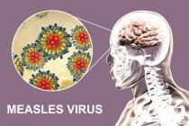 Encéphalite causée par le virus de la rougeole, illustration numérique . — Photo de stock