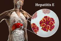 Ilustración digital de la silueta con inflamación hepática y primer plano del virus de la hepatitis E
. - foto de stock