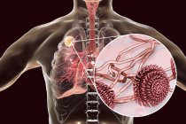 Aspergiloma de los pulmones y primer plano del hongo Aspergillus, ilustración digital . - foto de stock
