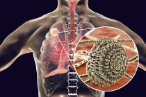 Aspergilloma dei polmoni e primo piano del fungo Aspergillus, illustrazione digitale
. — Foto stock