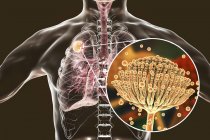 Aspergiloma de los pulmones y primer plano del hongo Aspergillus, ilustración digital . - foto de stock