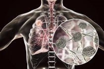 Aspergilloma dei polmoni e primo piano del fungo Aspergillus, illustrazione digitale . — Foto stock