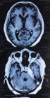 Магнитно-резонансная томография человеческого мозга . — стоковое фото