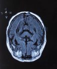 Магнітно-резонансна томографія мозку людини . — стокове фото
