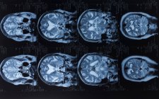 Risonanza magnetica scansioni di imaging del cervello umano . — Foto stock