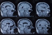 Imágenes por resonancia magnética del cerebro humano . - foto de stock