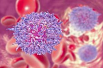 Illustration numérique des cellules sanguines anormales infectées par la leucémie à cellules poilues
. — Photo de stock