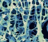 Coloured scanning electron micrograph of human cancellous spongy bone tissue. — Stock Photo