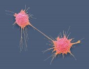 Células cancerosas de próstata divididas, micrografía electrónica de barrido coloreada . - foto de stock