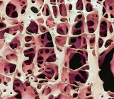 Micrographie électronique à balayage coloré du tissu osseux spongieux cancelleux humain . — Photo de stock