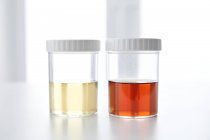 Sang dans l'urine humaine dans des pots d'échantillons, plan studio . — Photo de stock