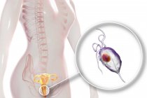 Illustration des weiblichen Fortpflanzungssystems und des parasitären Trichomonas vaginalis, der Trichomoniasis verursacht. — Stockfoto