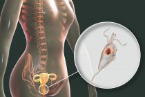 Illustrazione del sistema riproduttivo femminile e del parassita Trichomonas vaginalis che causa trichomoniasi . — Foto stock