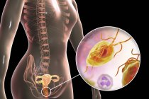 Ilustración del sistema reproductor femenino y parásito Trichomonas vaginalis causante de tricomoniasis . - foto de stock