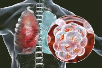 Illustrazione di batteri a forma di asta all'interno di alveoli dei polmoni che causano infezioni delle basse vie respiratorie . — Foto stock