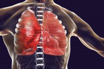 Пневмонія Запальні стану легенів, цифрова ілюстрація. — стокове фото
